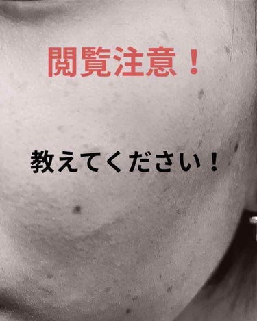 肌ラボ 極潤 ハトムギ泡洗顔のクチコミ「教えてください！

今の肌の状態です！
ニキビ極潤の洗顔を朝に使い、
ハトムギ化粧水をしてから.....」（1枚目）