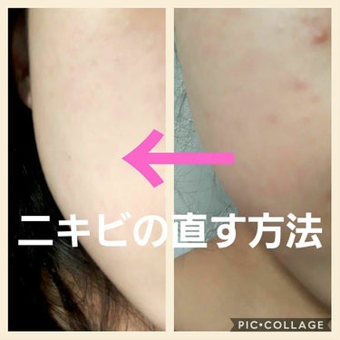 나 나 🇰🇷 on LIPS 「こんにちは⭐나나ですっっ！今回は、ニキビ直す方法を紹介します！..」（1枚目）