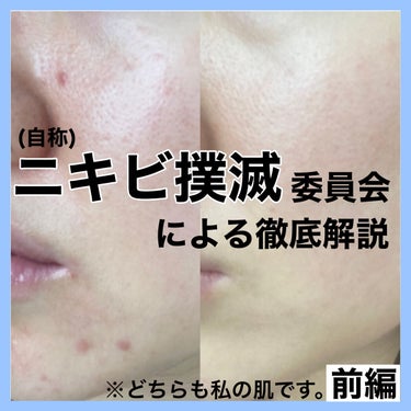 紗々🌸フォロバ100(投稿ある方) on LIPS 「ニキビ撲滅するにはまずニキビの特徴を知れということでニキビとは..」（1枚目）