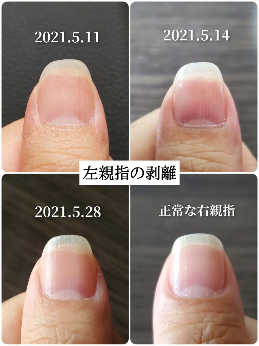 クイックケアコート Ettusaisの口コミ 爪甲剥離症の育爪記録以前の投稿はこちらに By かぴめろん 気力ダウン 乾燥肌 40代後半 Lips