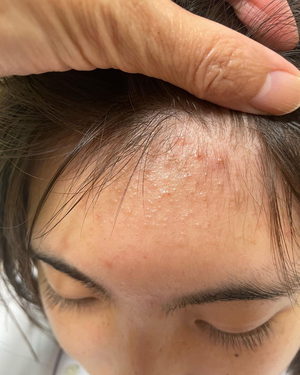 ミラクルアクネクリアスポットトリートメント/SOME BY MI/美容液を使ったクチコミ（3枚目）