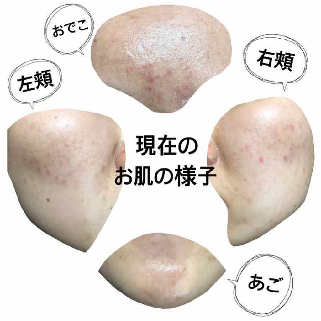 うずら on LIPS 「こんにちは!うずらです!先日、皮膚科に行って薬を処方してもらい..」(4枚目)