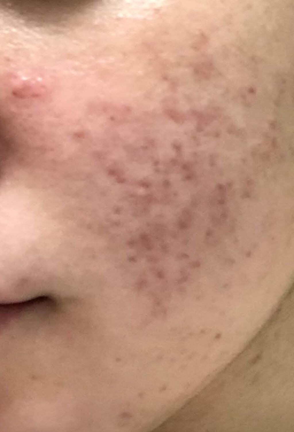 バイオイル/バイオイル/フェイスオイルを使ったクチコミ（1枚目）