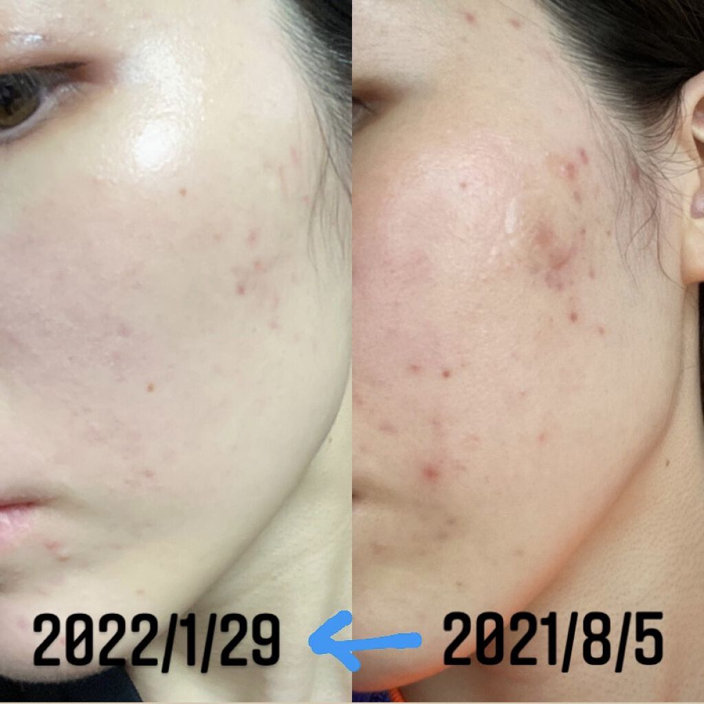 イハダ 薬用バーム【医薬部外品】/IHADA/フェイスバームを使ったクチコミ（1枚目）