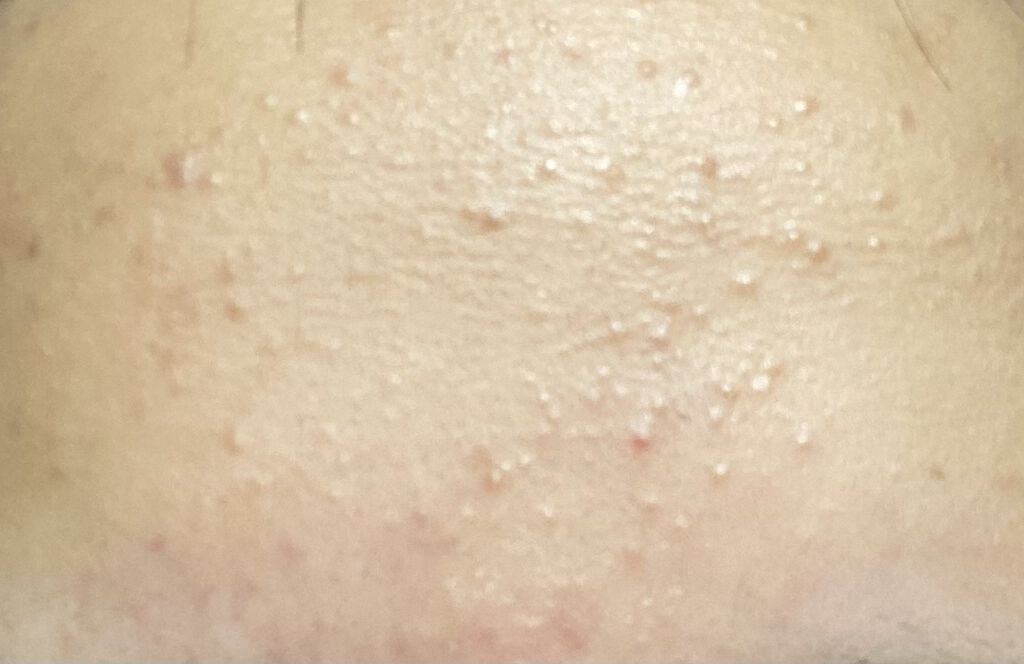 ペアアクネクリームW(医薬品)/ペア/その他を使ったクチコミ（2枚目）