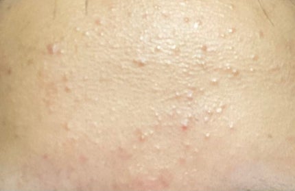 ペアアクネクリームW(医薬品)/ペア/その他を使ったクチコミ(2枚目)