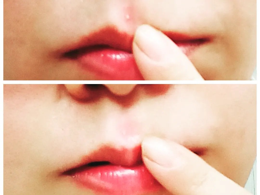 pink_gloss_qbpf on LIPS 「ニキビパッチの【ニキパ!】を使ってみたよニキパはなんと、透明な..」(5枚目)