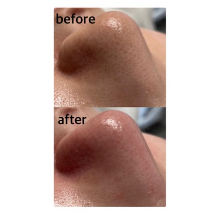 憫(びん) on LIPS 「【たった1000円! 毛穴が気になる方必見‼︎😳】 ⚠️bef..」(4枚目)