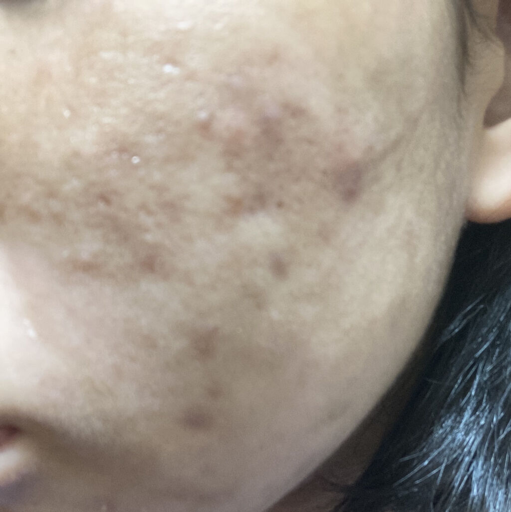 オロナインＨ軟膏 (医薬品)/オロナイン/その他を使ったクチコミ（3枚目）