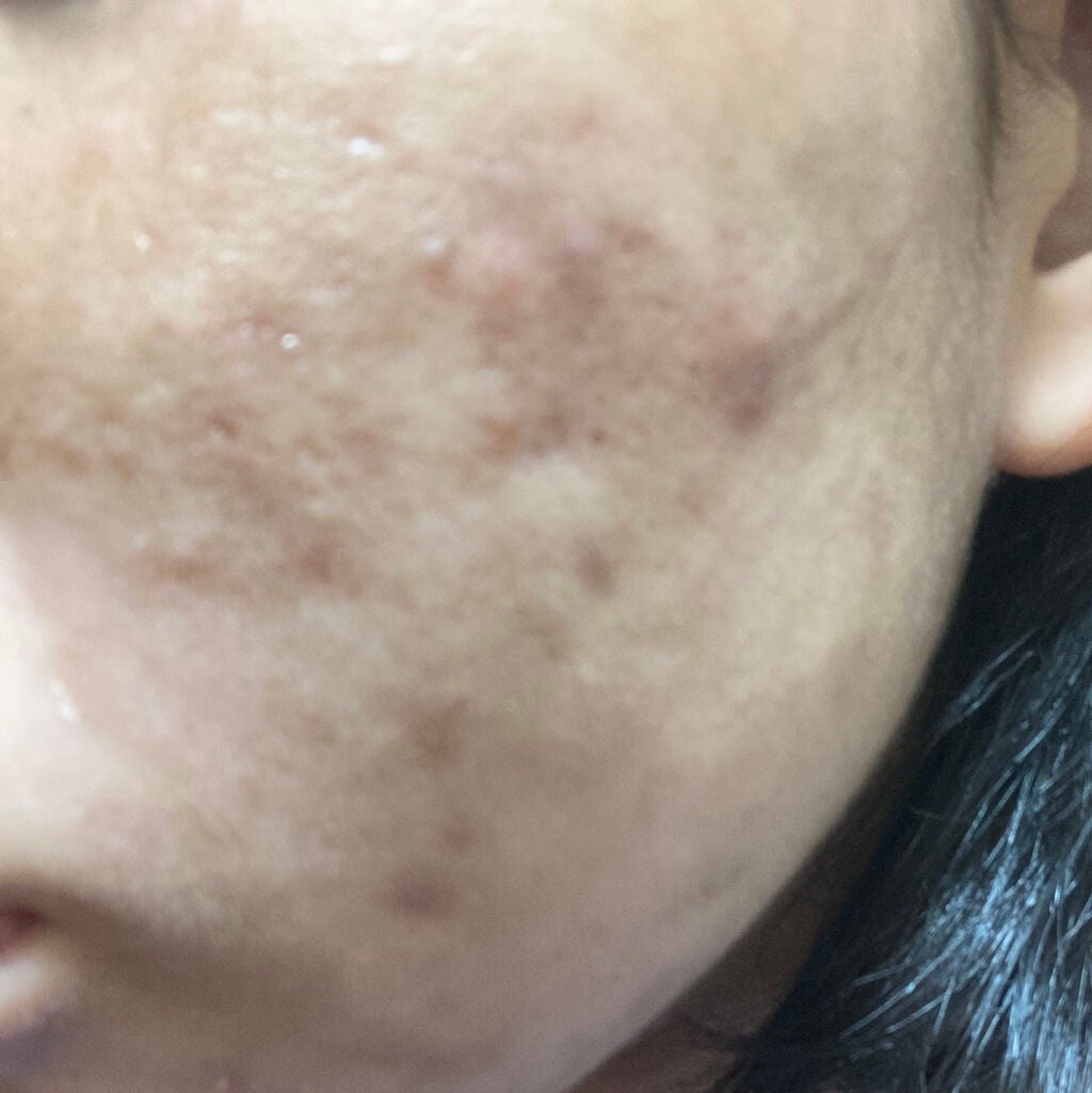 オロナインH軟膏 (医薬品)/オロナイン/その他を使ったクチコミ(3枚目)