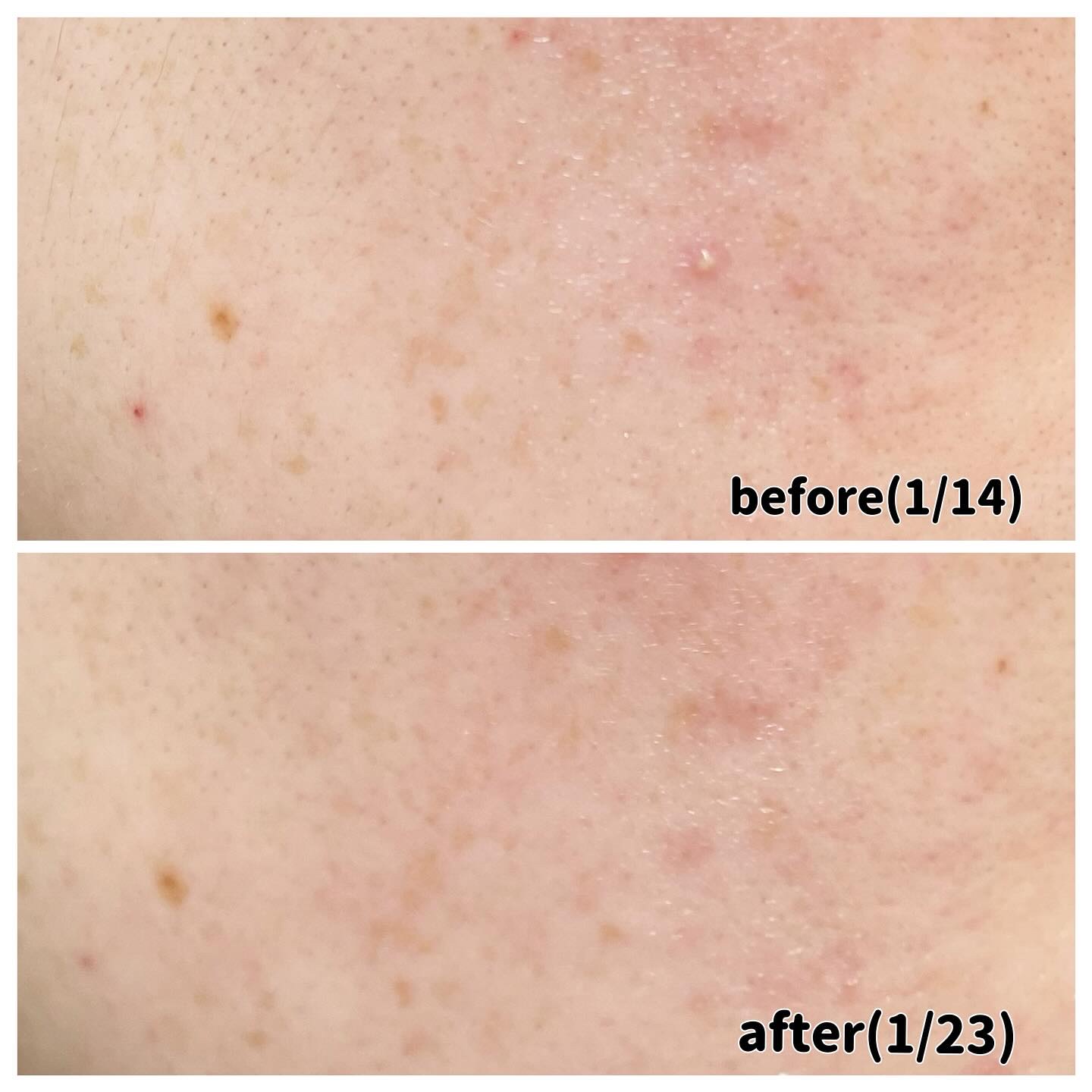 PDRNピンクアンプル PDRN 10,000ppm配合/MEDICUBE/美容液を使ったクチコミ（3枚目）