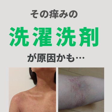 美肌カウンセラー💆綺麗のお助け相談所 on LIPS 「何をやっても改善しないアトピー。ニキビや肌荒れ。もしかしたら"..」（1枚目）