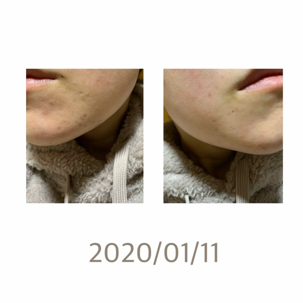 ベピオゲル/マルホ株式会社/その他を使ったクチコミ（1枚目）