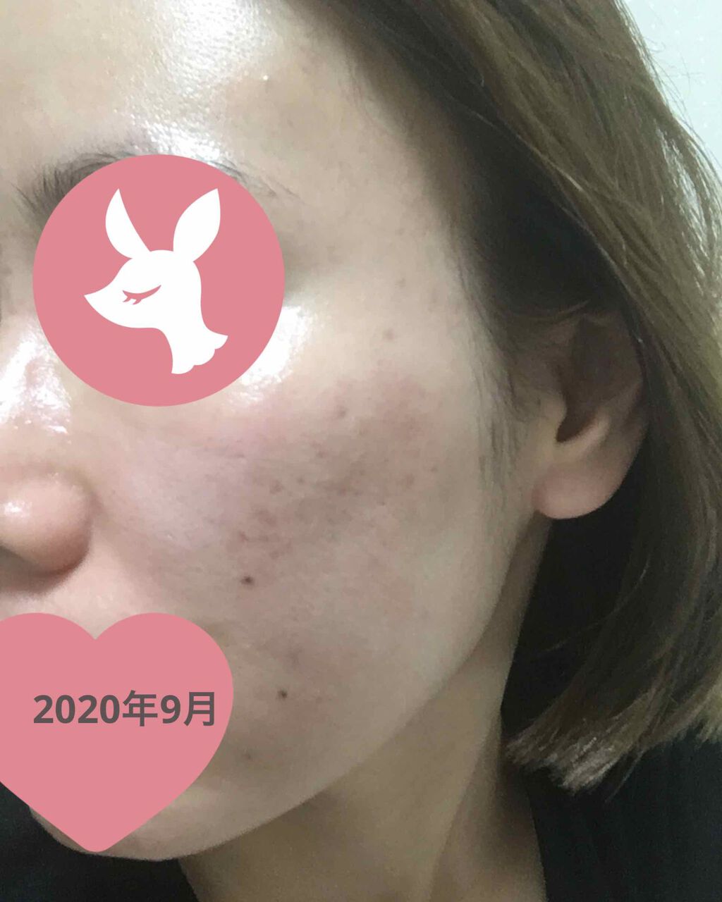 ベピオゲル/マルホ株式会社/その他を使ったクチコミ（2枚目）