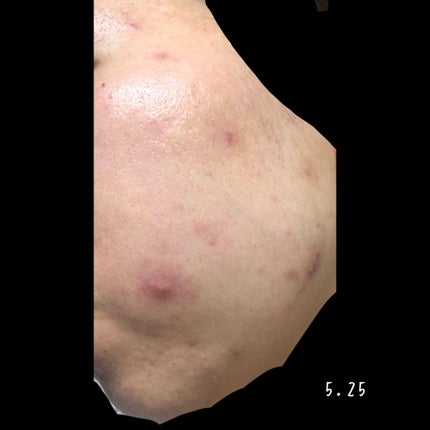 ベジータ on LIPS 「下書き消化! 5.21〜5.30オルビスのニキビケアシリーズ気..」(4枚目)