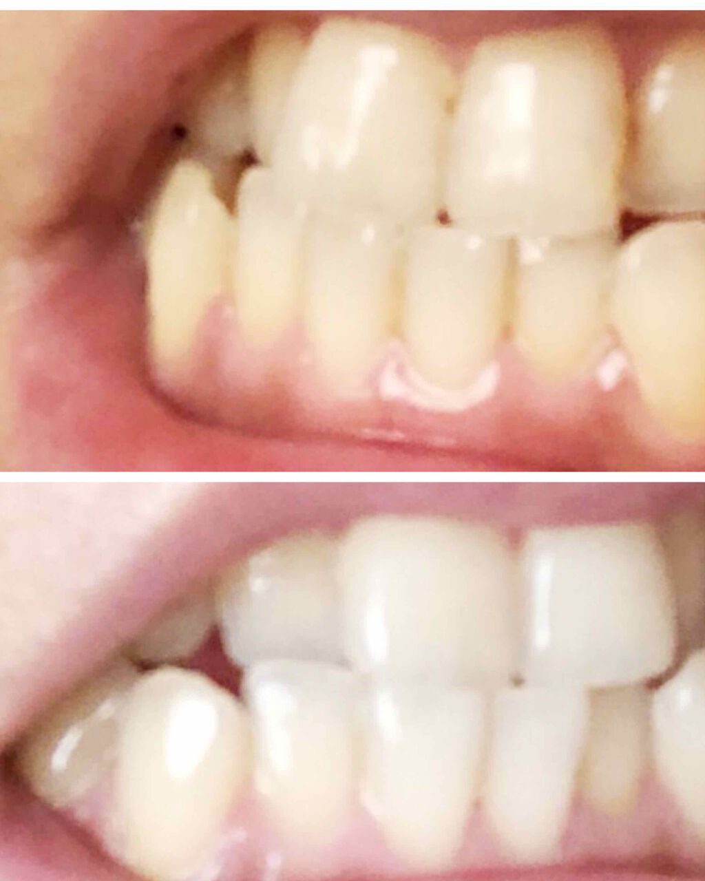 HITEETH ALL IN ONE MOUTH GEL/R&/歯磨き粉を使ったクチコミ（3枚目）