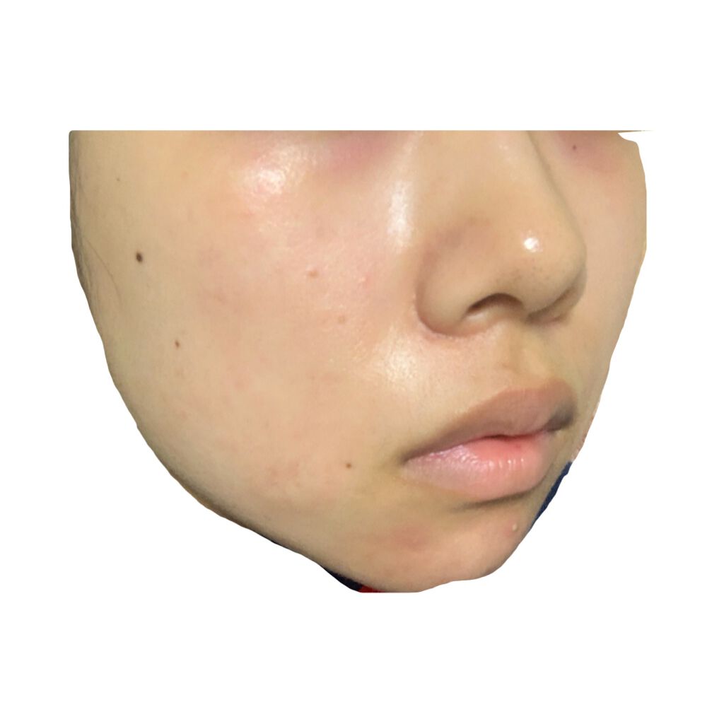 ベピオゲル/マルホ株式会社/その他を使ったクチコミ（1枚目）