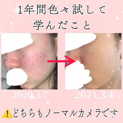 オードムーゲ 薬用ローション(ふきとり化粧水)/オードムーゲ/拭き取り化粧水を使ったクチコミ(1枚目)