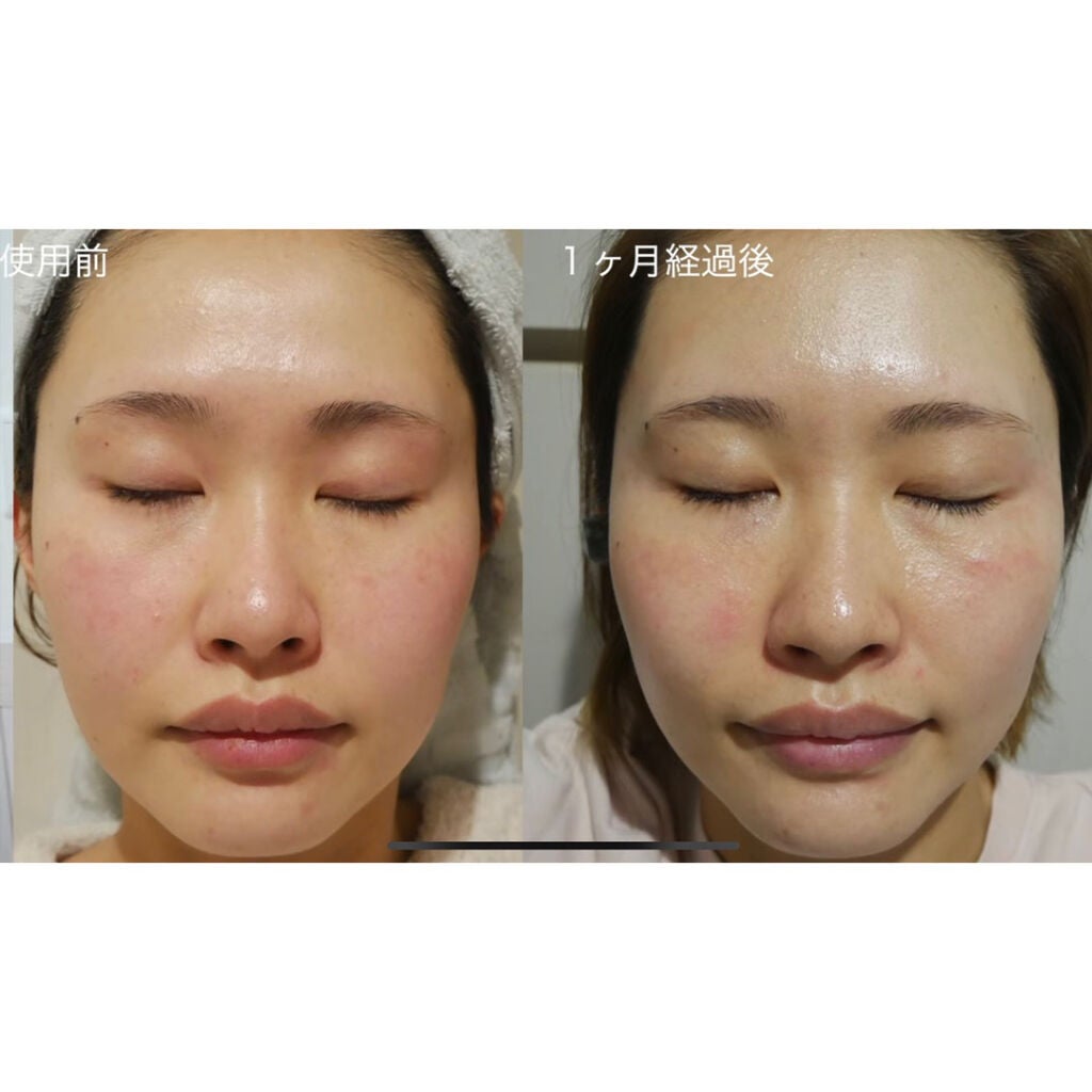 みーきです。 on LIPS 「大人気のレチノールA1%クリーム 1ヶ月検証してみました!↓↓..」(2枚目)