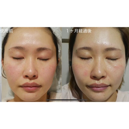 みーきです。 on LIPS 「大人気のレチノールA1%クリーム 1ヶ月検証してみました!↓↓..」(2枚目)