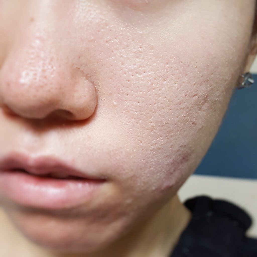 ミネラルカバー薬用美白ファンデセラム/ミリオナ化粧品/美容液を使ったクチコミ(5枚目)