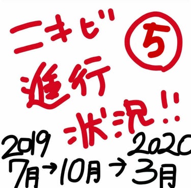 こんにちは、ぽんこです！（閲覧注意です！！！）

とりあえず、この変化見てください、、。



まず1枚目。まじで凹凸激しいですね。鏡見て毎回泣いてました😂メイクしないよりも酷く見えちゃうんですよね……