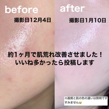 はるかの美容垢🐰 on LIPS 「約1ヶ月で肌荒れ改善させました！いいねが多かったら今度詳しく投..」（1枚目）