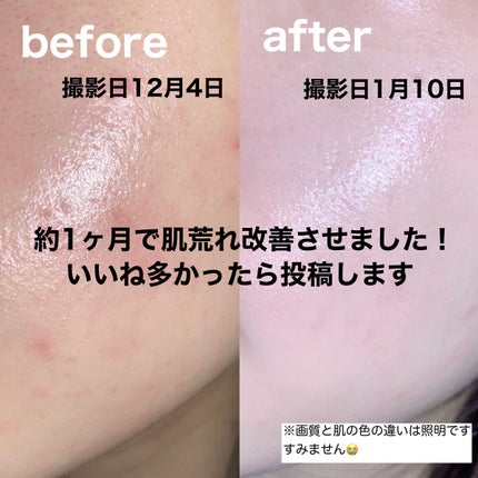 はるかの美容垢🐰 on LIPS 「約1ヶ月で肌荒れ改善させました!いいねが多かったら今度詳しく投..」(1枚目)