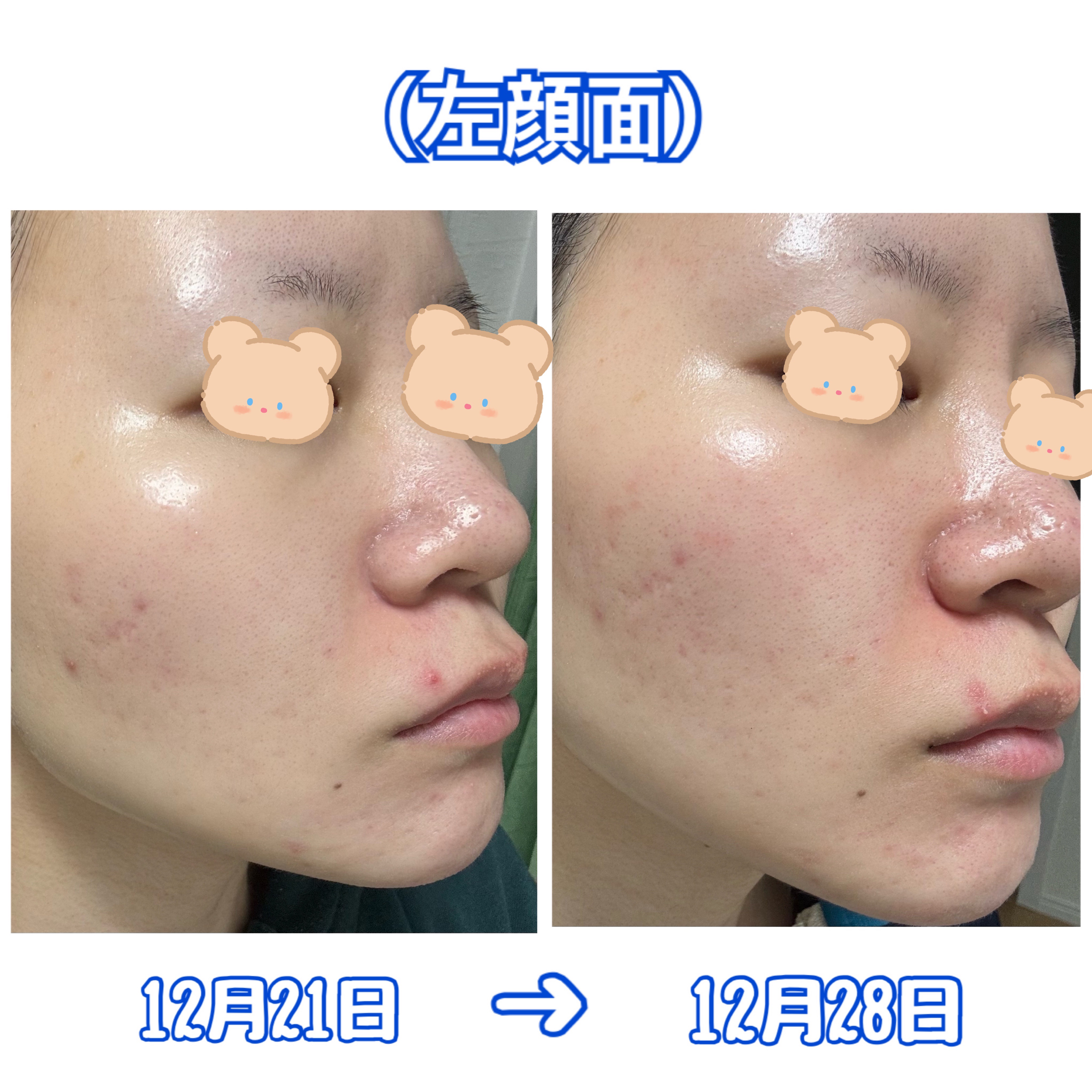 レチノール0.3 ナイアシンリニューイングセラム/Anua/美容液を使ったクチコミ（3枚目）