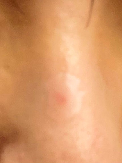 プロCICA クリアスポットパッチ/VT/その他スキンケアを使ったクチコミ(3枚目)