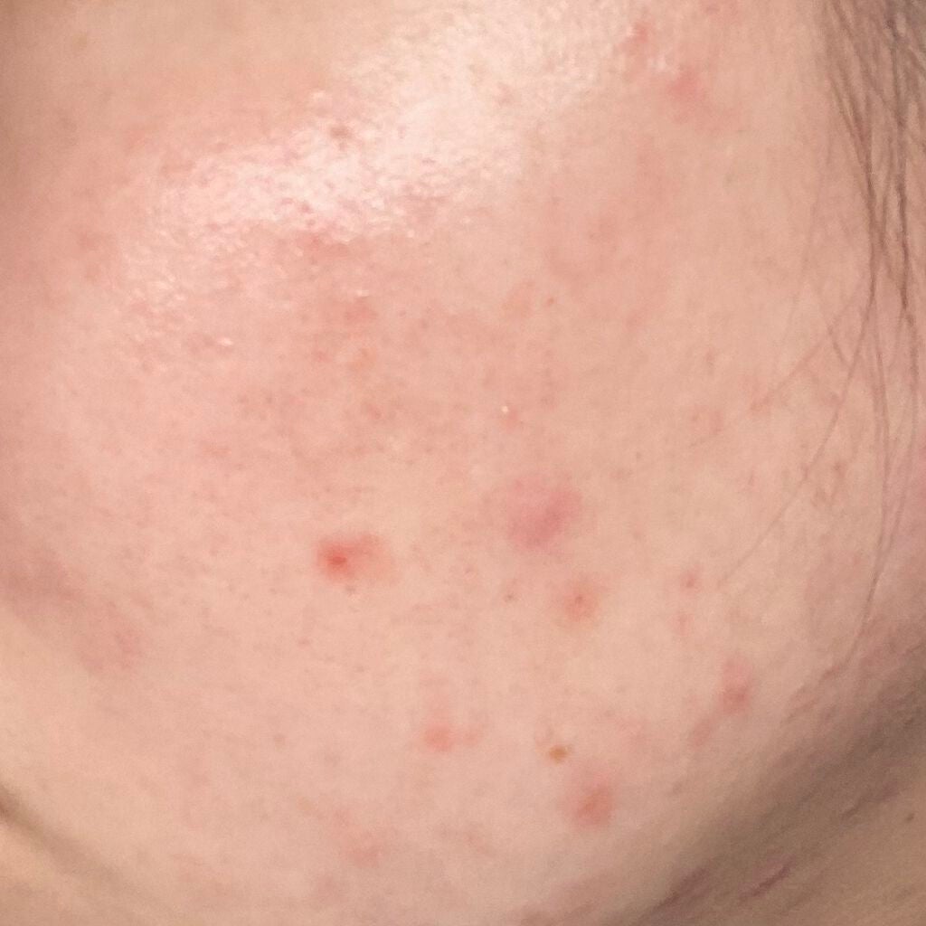 ぺんぎん on LIPS 「⚠️閲覧注意⚠️ニキビに効く薬、化粧品、パックとか色々試してみ..」(2枚目)