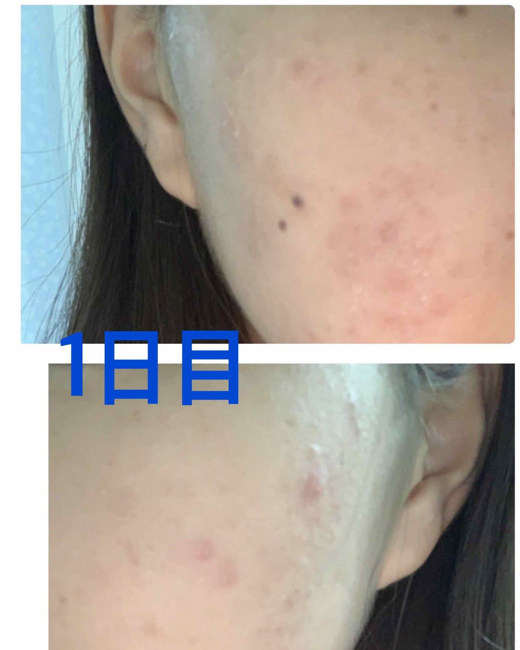 ニキビ治療薬クリーム (医薬品)/クレアラシル/その他を使ったクチコミ(2枚目)