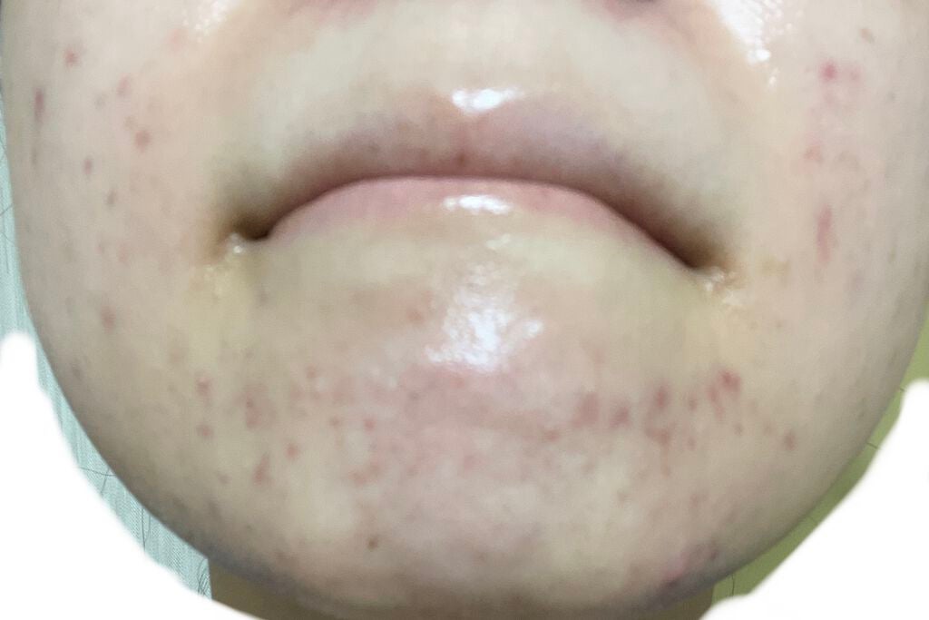 まままこ on LIPS 「ニキビゼロ肌を目指して〜8/19〜⚠️2枚目から肌画像ありスキ..」(4枚目)