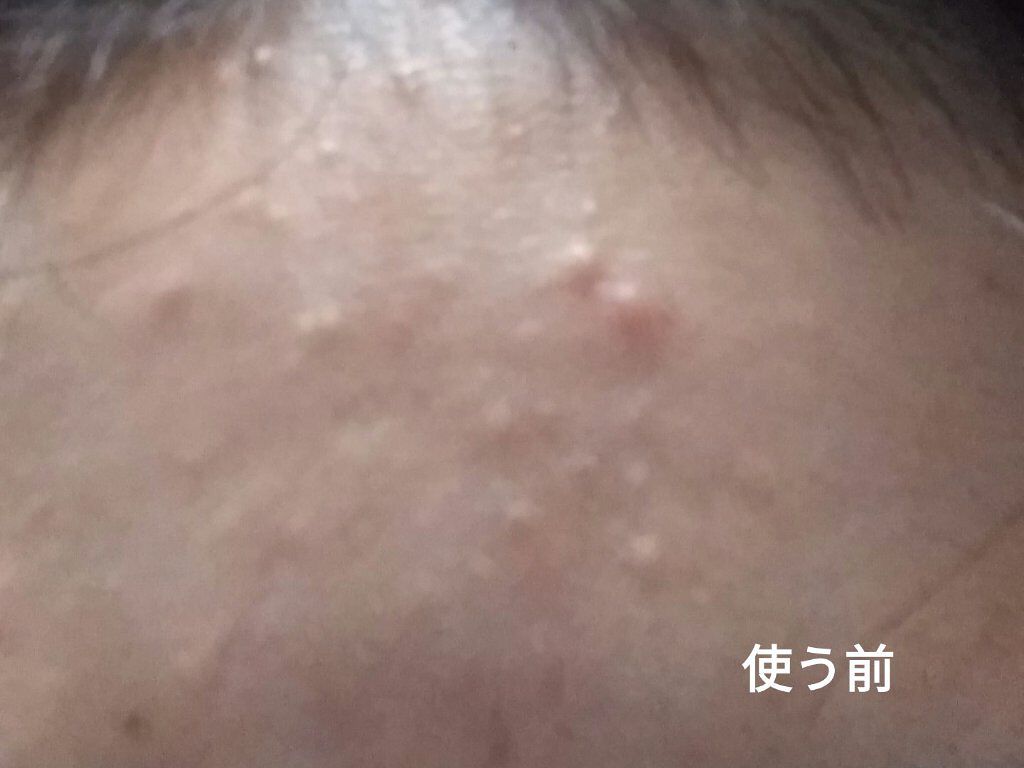 薬用ふわふわな泡洗顔/メンソレータム アクネス/泡洗顔を使ったクチコミ(2枚目)