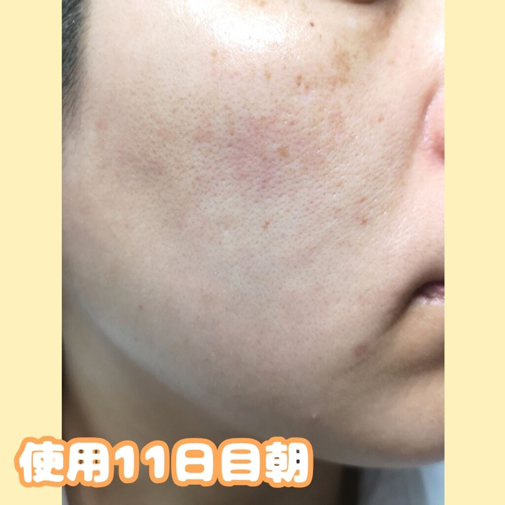 ホワイトニングクリアエマルジョン/d プログラム/乳液を使ったクチコミ（2枚目）