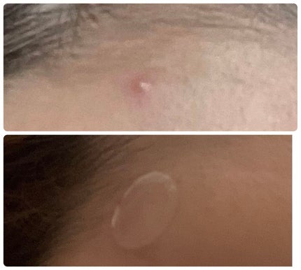 プロCICA クリアスポットパッチ/VT/その他スキンケアを使ったクチコミ(5枚目)