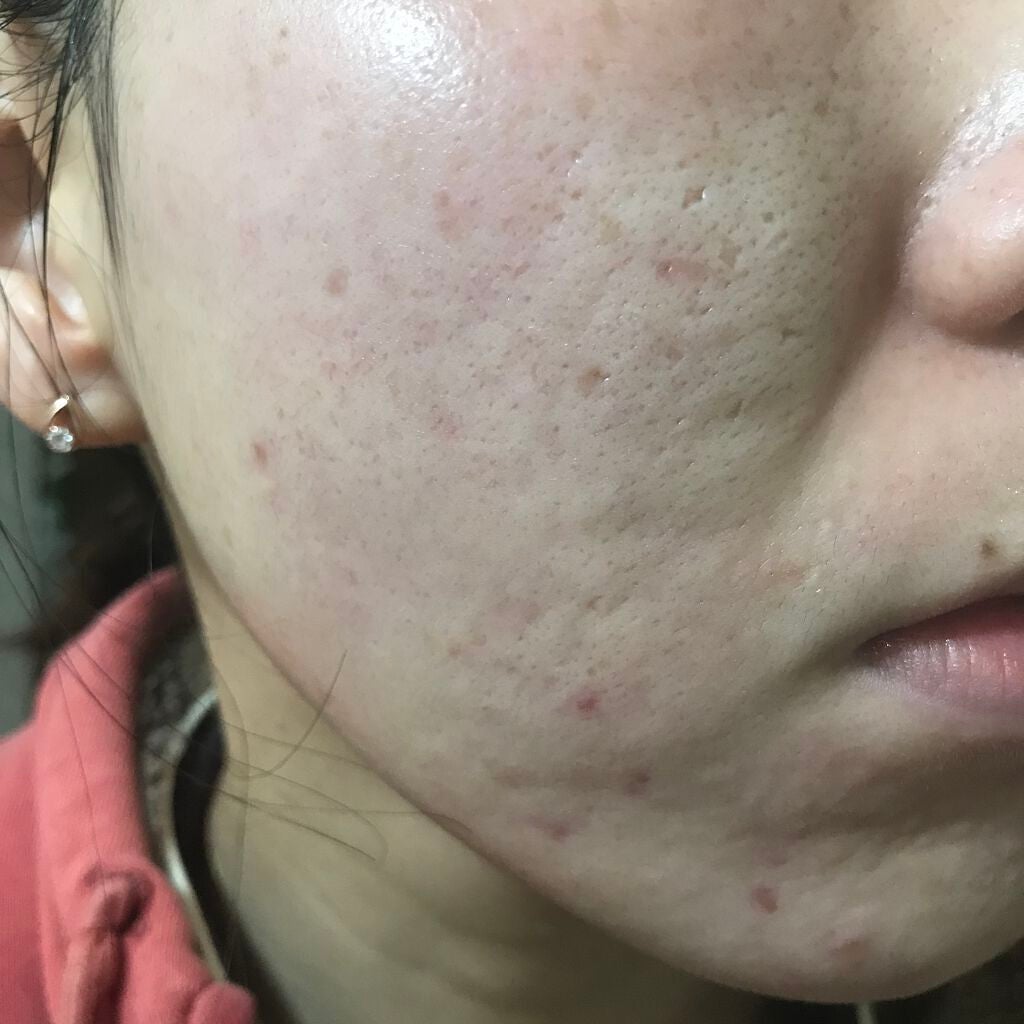 ティーツリーケア ソリューション エッセンシャルマスクEX/MEDIHEAL/シートマスク・パックを使ったクチコミ(1枚目)