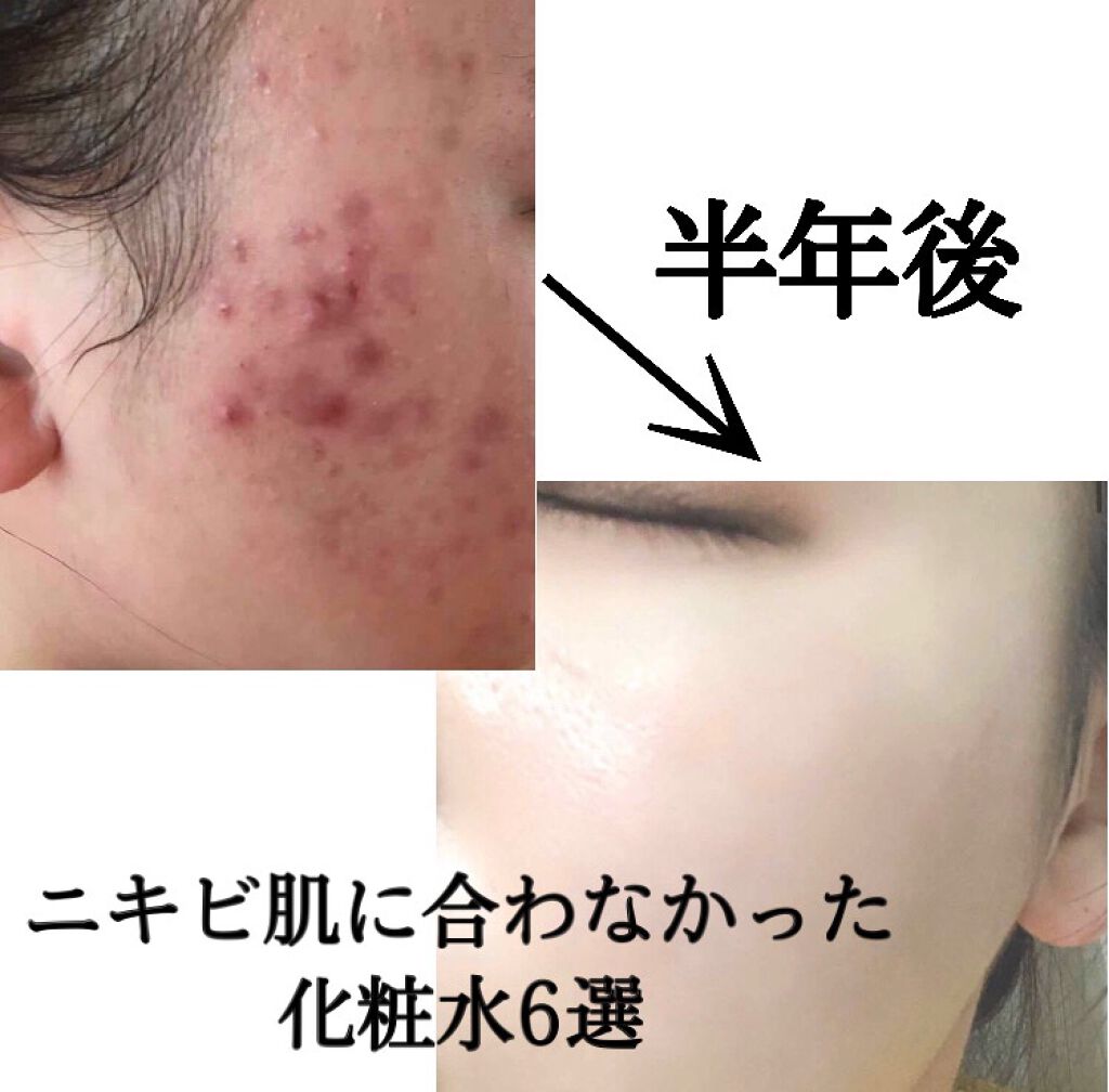 薬用アクネコントロール フレッシュ ローション/DHC/化粧水を使ったクチコミ（1枚目）