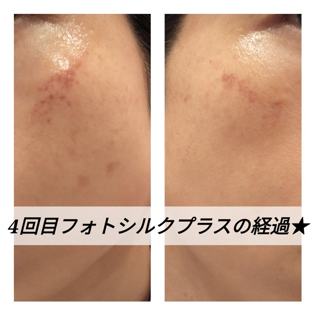 あにゃにゃ♡フォロバ100♡ on LIPS 「11/12に4回目のフォトシルクプラス(シミ取り)を受けてきま..」(1枚目)