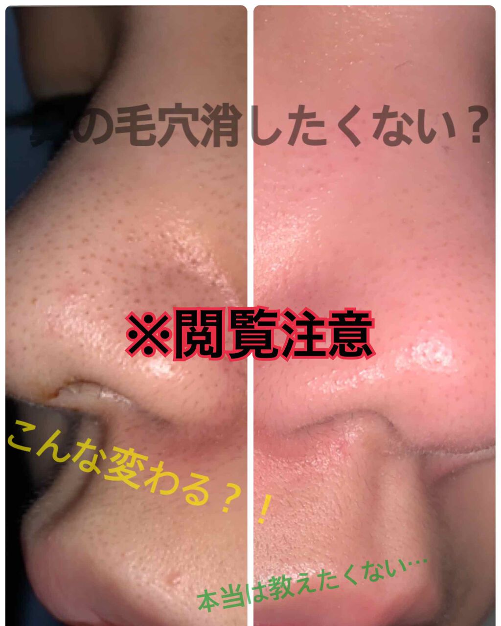 可愛くなりたい子必見🍓 on LIPS 「皆さんこんにちは!いかです!突然ですが皆さん、鼻の毛穴気になり..」(1枚目)