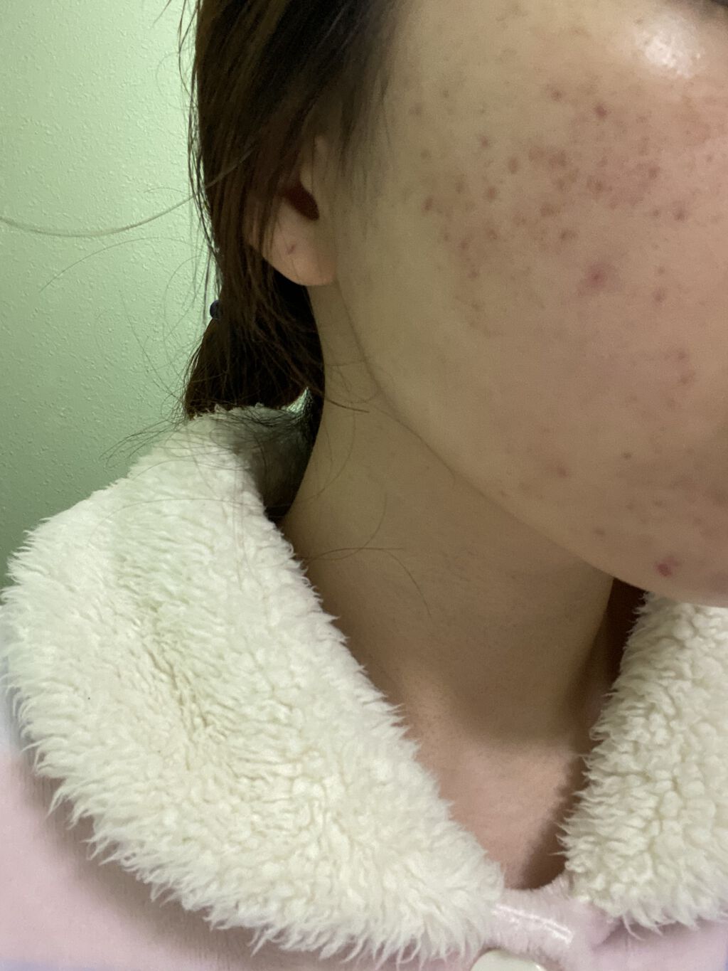 ペアアクネクリームW(医薬品)/ペア/その他を使ったクチコミ（2枚目）