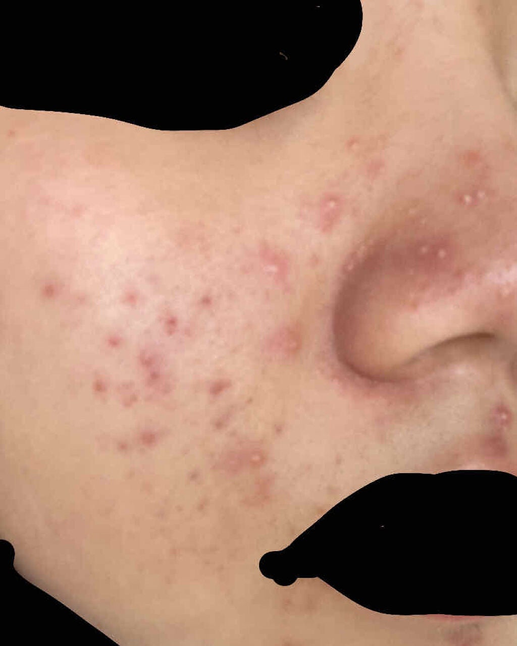 fabulous_perfume_1oau on LIPS 「ニキビ治したいです。。今の現状は・お菓子たくさん食べている・洗..」(1枚目)