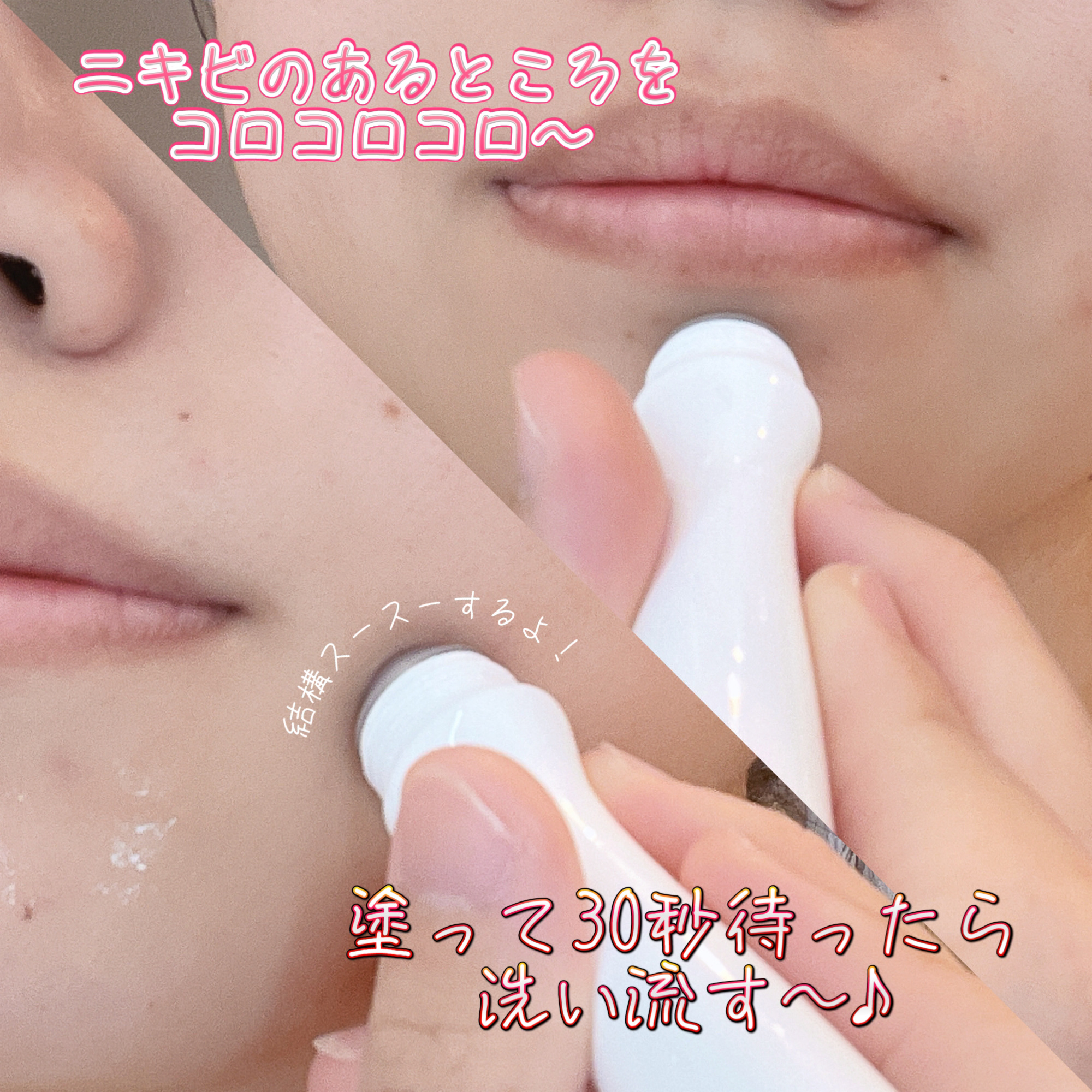 P.CALM ABC クリアトックのクチコミ「❤️ニキビ撃退❤️
【P.CALM　ABC クリアトック】

️みなさんこんにちは！

今回紹.....」（2枚目）