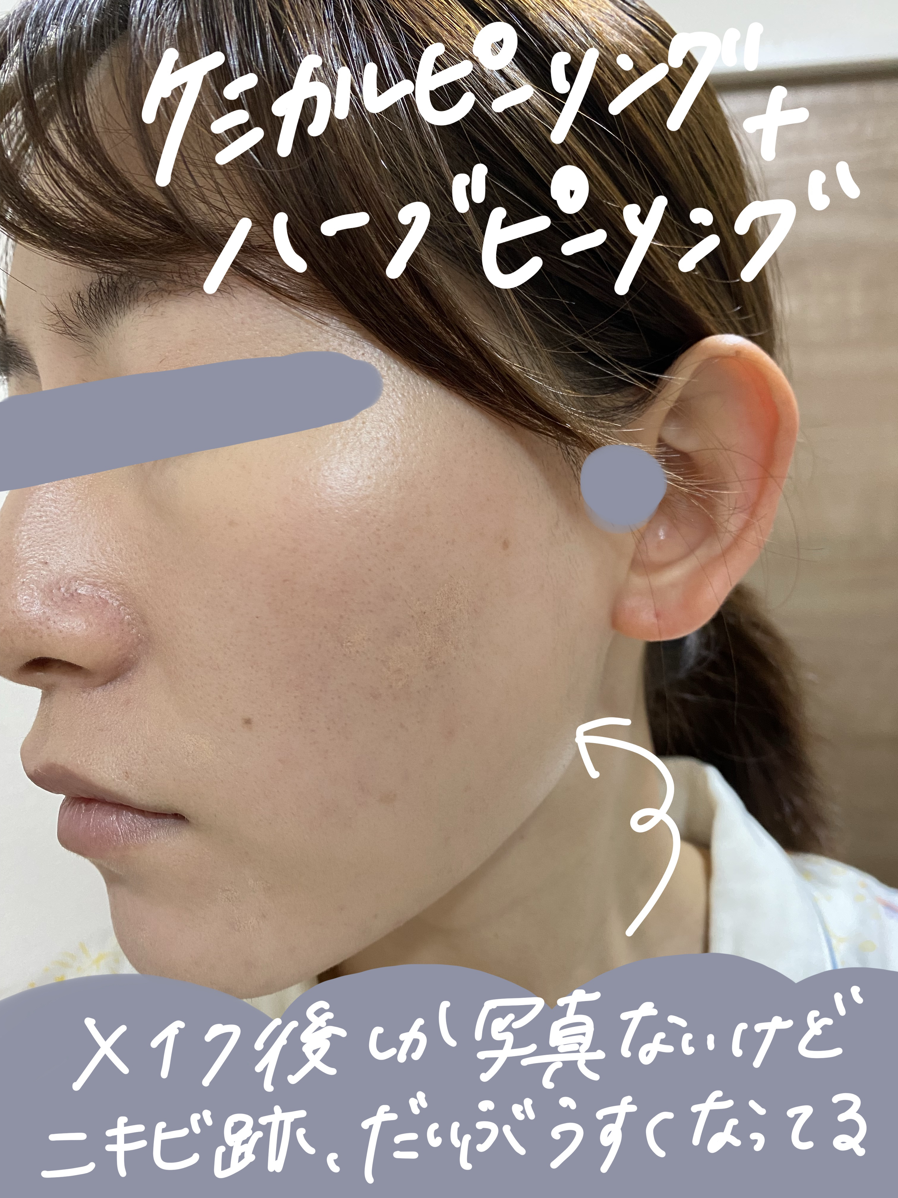 残り3名！さらに300円オフ中‼️✨REVI陶肌ハーブピーリング5回分 残り3名！さらに300円オフ中‼️✨REVI陶肌ハーブピーリング5回分