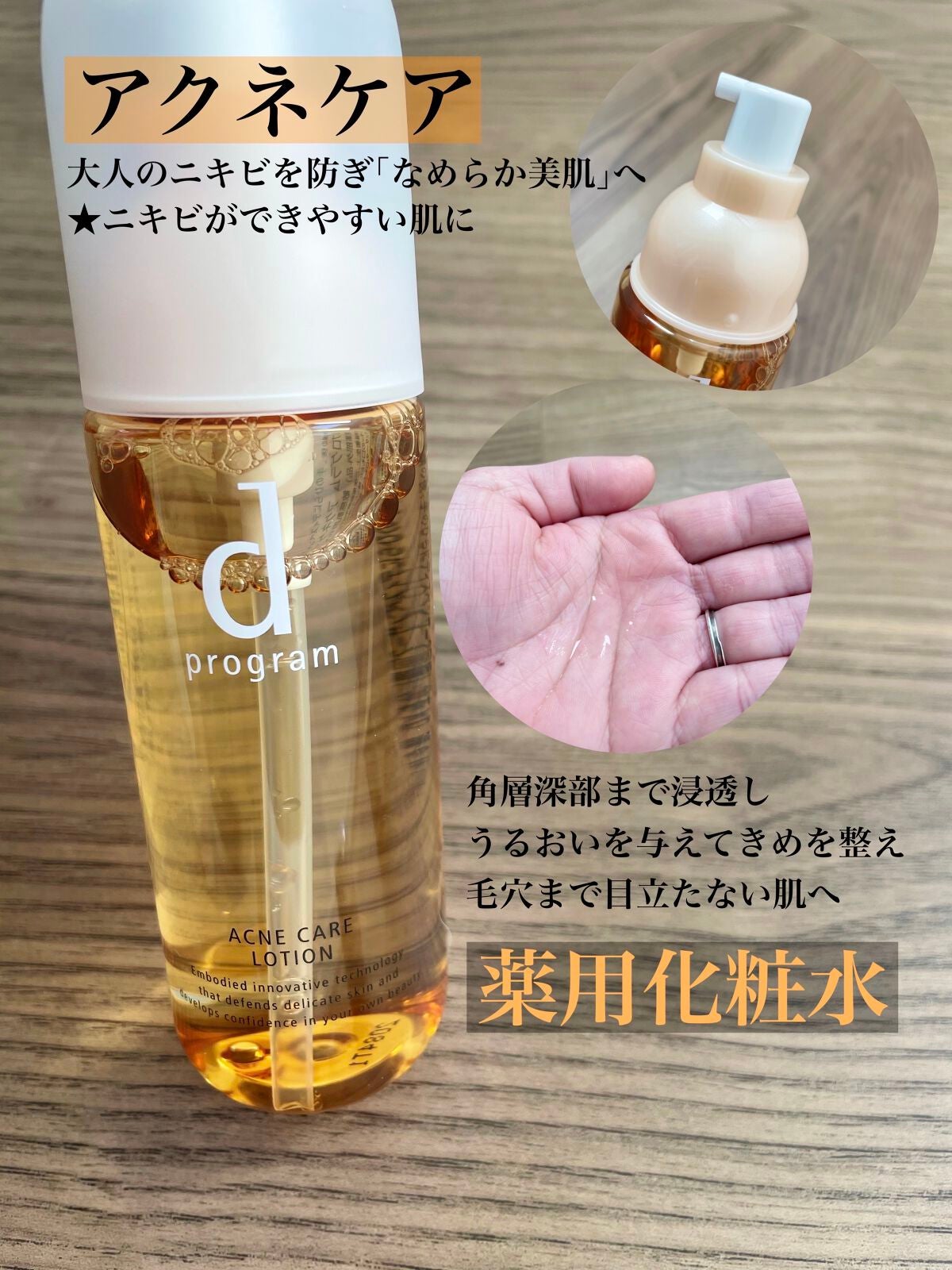 アクネケア ローション MB/d プログラム/化粧水を使ったクチコミ(2枚目)