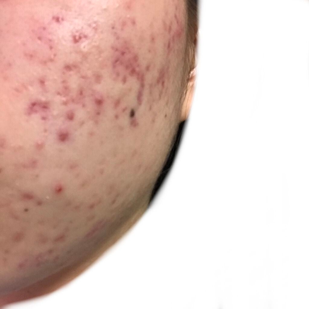 ぷぷぷ on LIPS 「ニキビ観察日記顎、口ら辺に赤いのがポツポツと...ちょっとスト..」(2枚目)