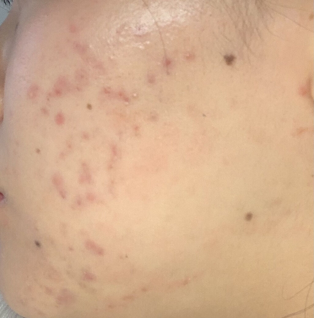 クリンダマイシンゲル(医薬品)/クラシエ薬品/その他を使ったクチコミ（1枚目）