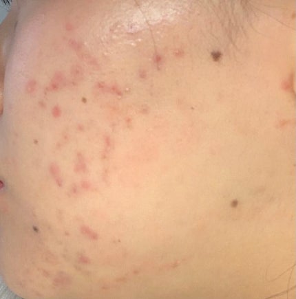 クリンダマイシンゲル(医薬品)/クラシエ薬品/その他を使ったクチコミ(1枚目)