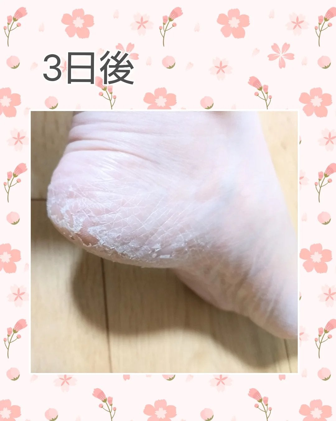 イージーパックDP60分タイプ 摘みたていちごの香り/ベビーフット/レッグ・フットケアを使ったクチコミ(6枚目)