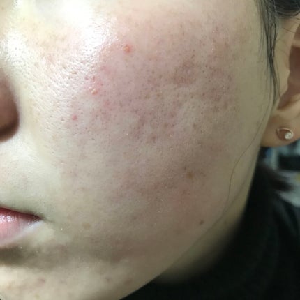 ゼロスポットパッチ/Today’s Cosme/にきびパッチを使ったクチコミ(2枚目)